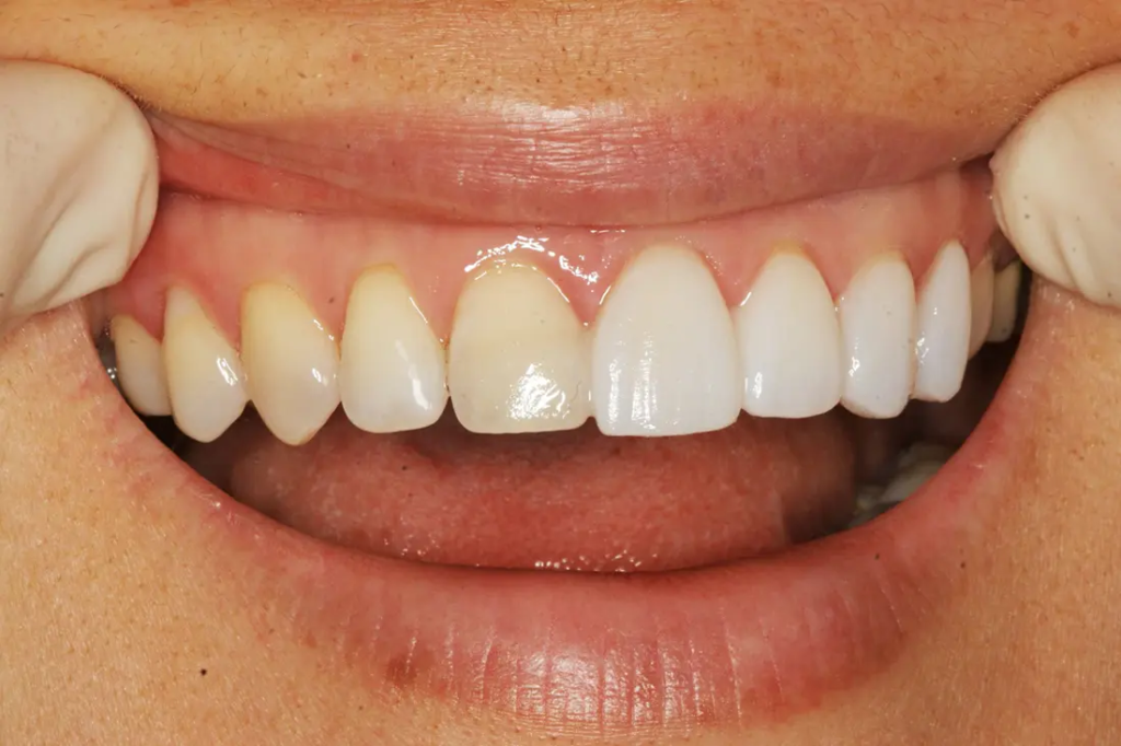 Porcelain Veneer