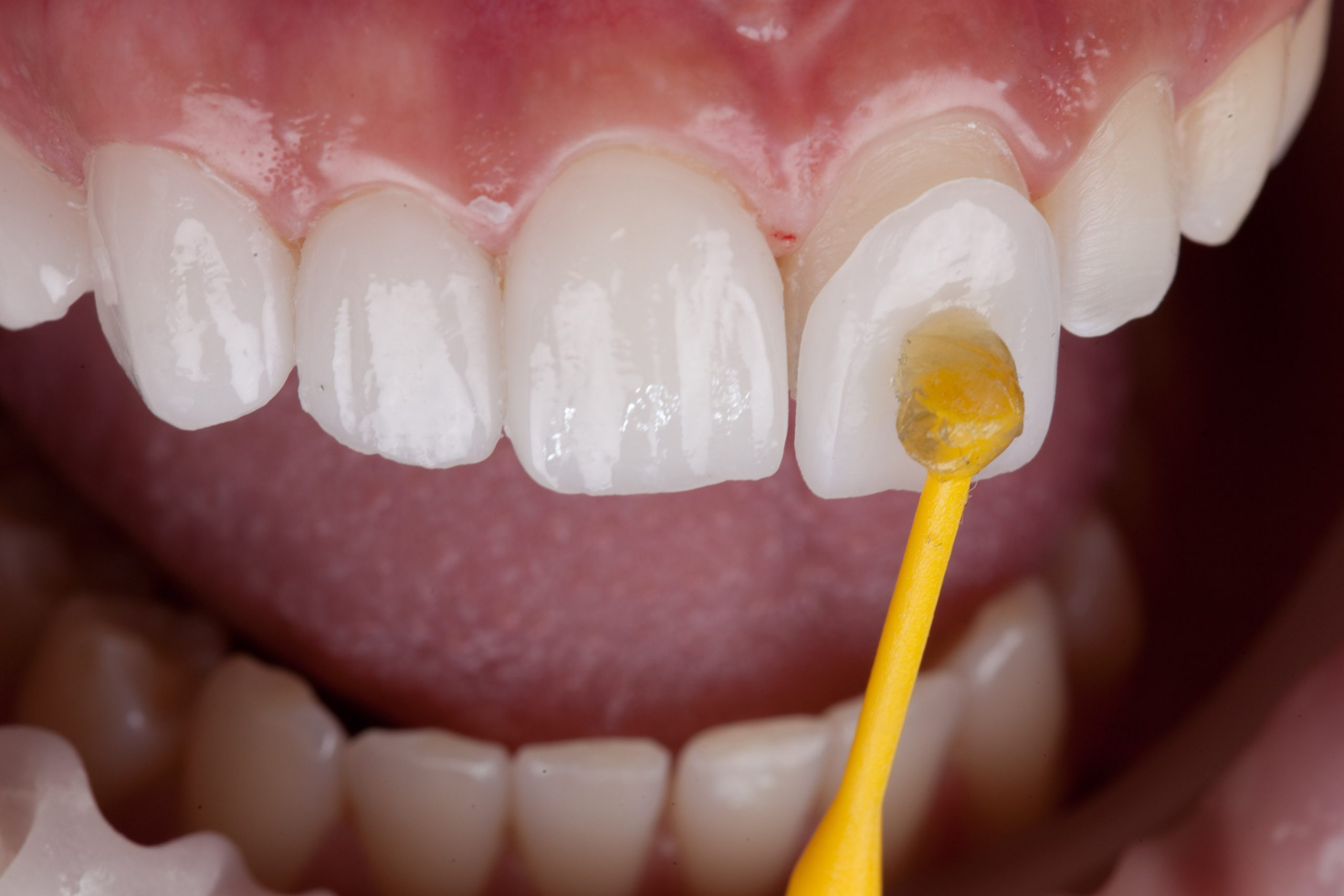 Teeth Whitening